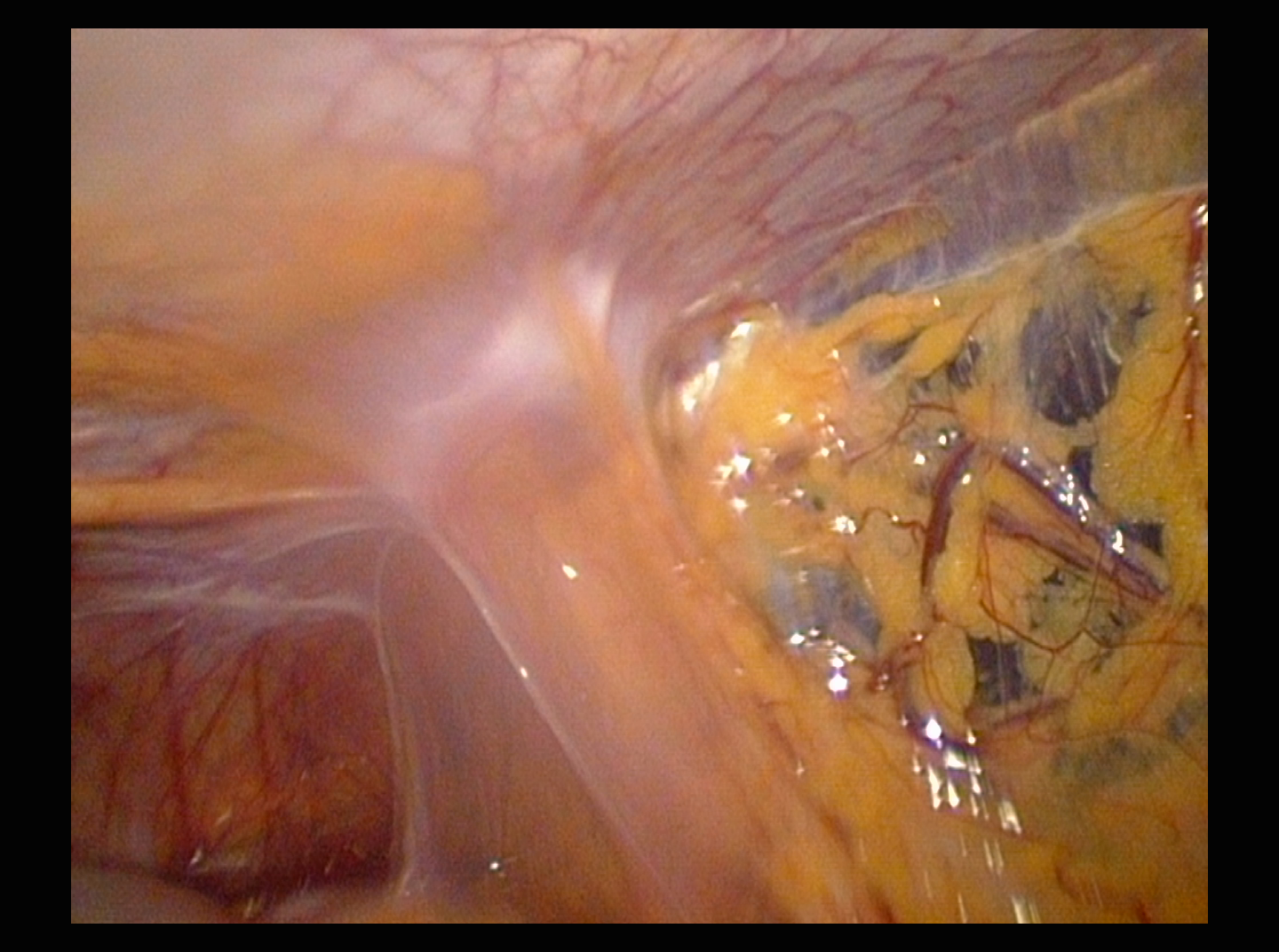 ADHESIONS BOWELS OMENTAL1 ADHESIONS BOWELS OMENTAL1
